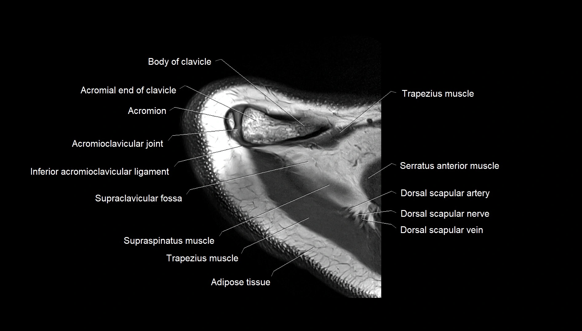 Shoulder cross sectional anatomy MRI 3T axial image 5.webp